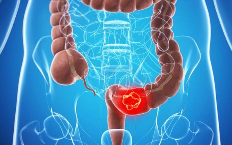 Chức năng tuyệt vời của Coenzyme Q10 là gì Phòng ngừa đáng kể căn bệnh ung thư